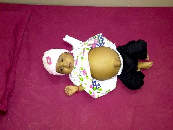 Help Baby Tahoora Begum Undergo A Liver Transplant