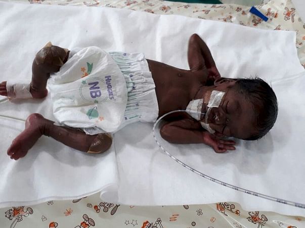 Help Twins of Amudha Get Ventilator Support