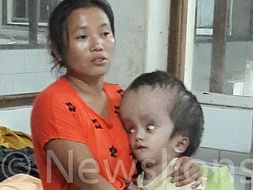 Little boy’s head swells to size of watermelon - Help Boisang