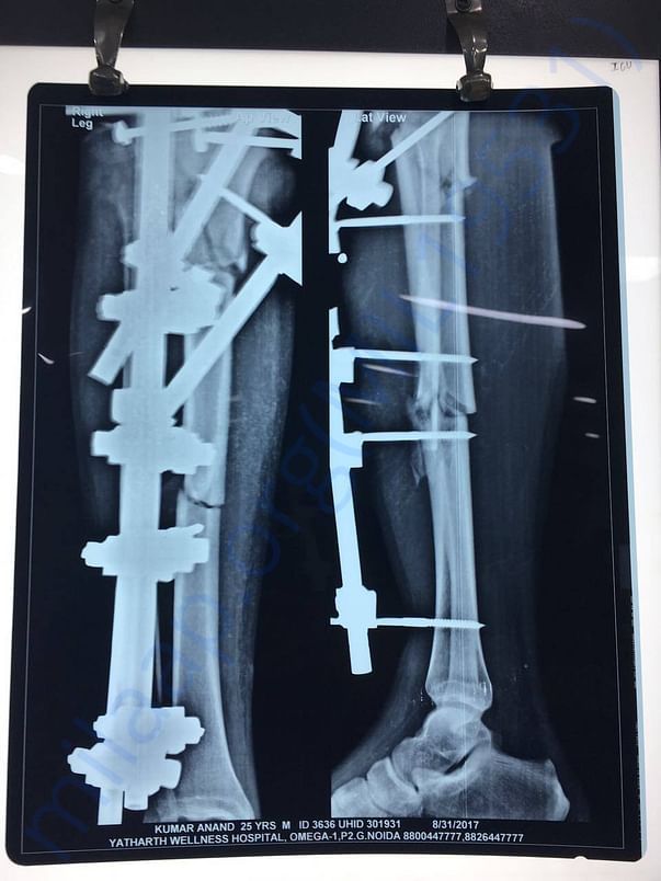 X ray of leg