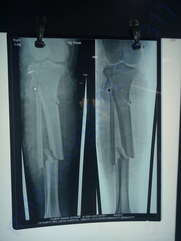 leg X-ray