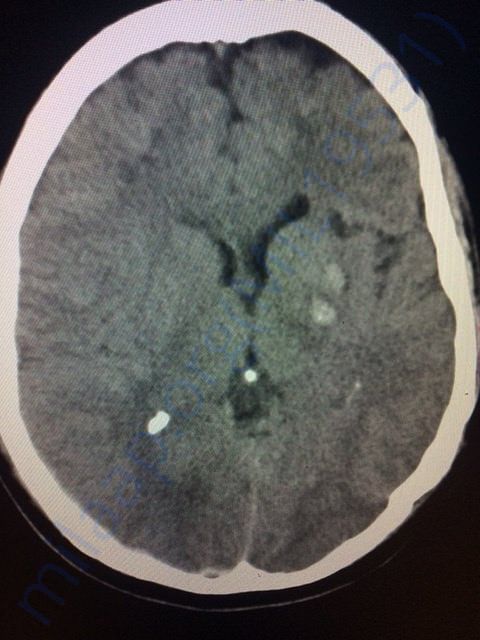 Brain CT scan
