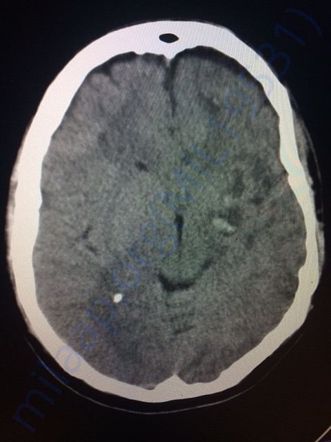Brain CT scan