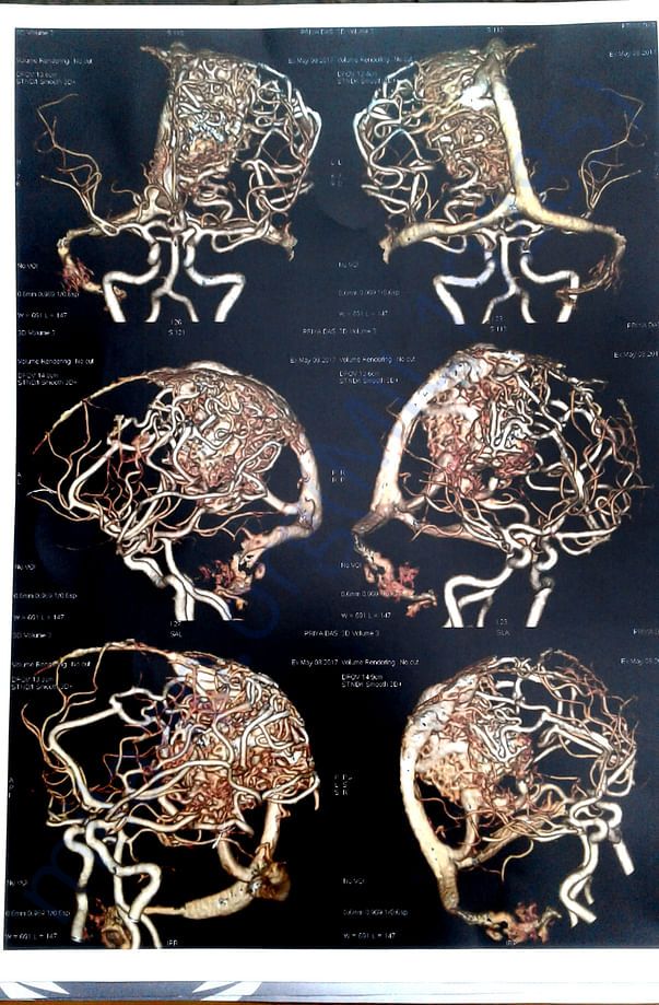 CT Angiography