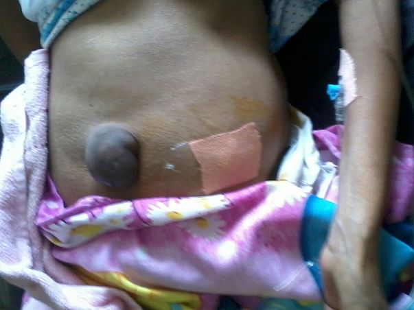Mother's treatment liver cirrhosis