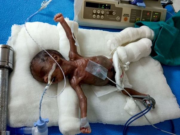 Please help my new born with 470 grams of weight at birth