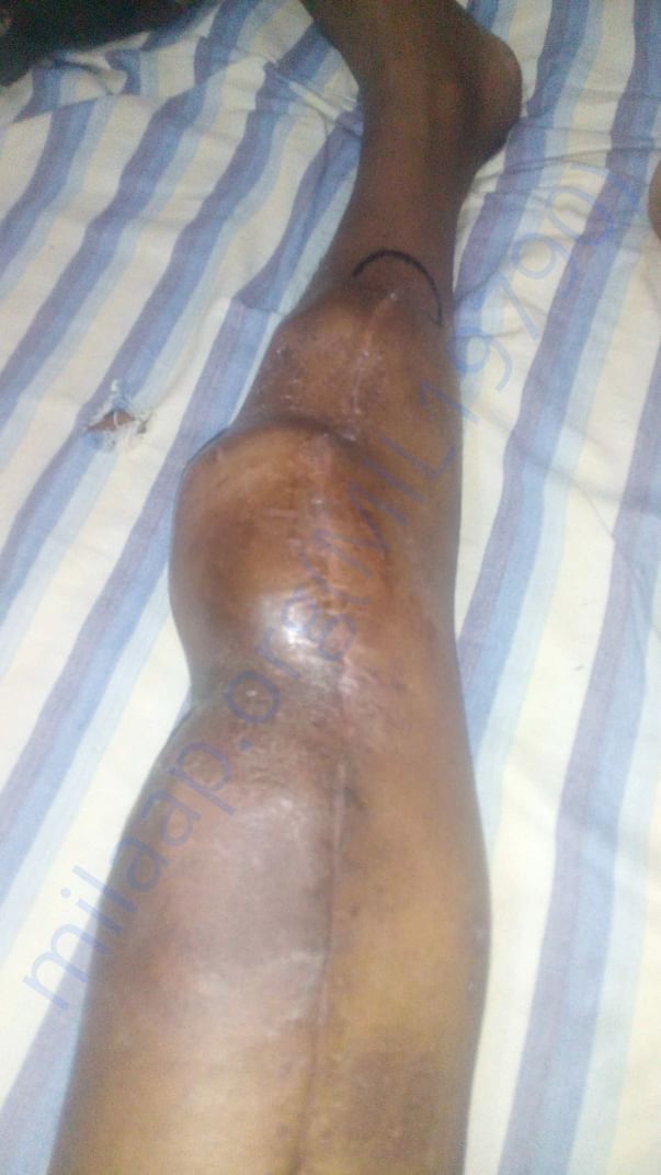 Before amputation