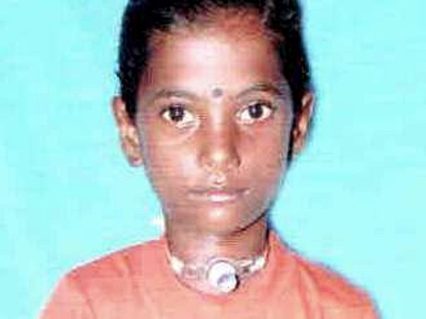 Help Sangeetha to recover from Severe Grade IV Subglotic Stenosis