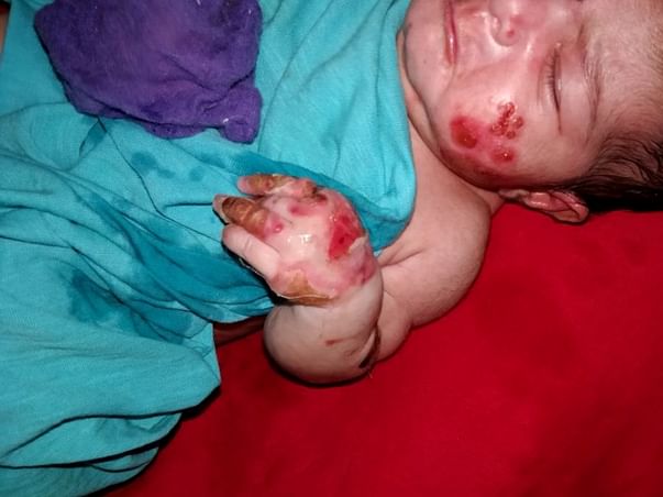 My 10-day Old daughter Is Suffering From A Skin Condition Please Help.