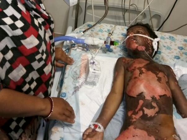 6 Year old kid Moiz Burnt Grievously in contact with high tension wire