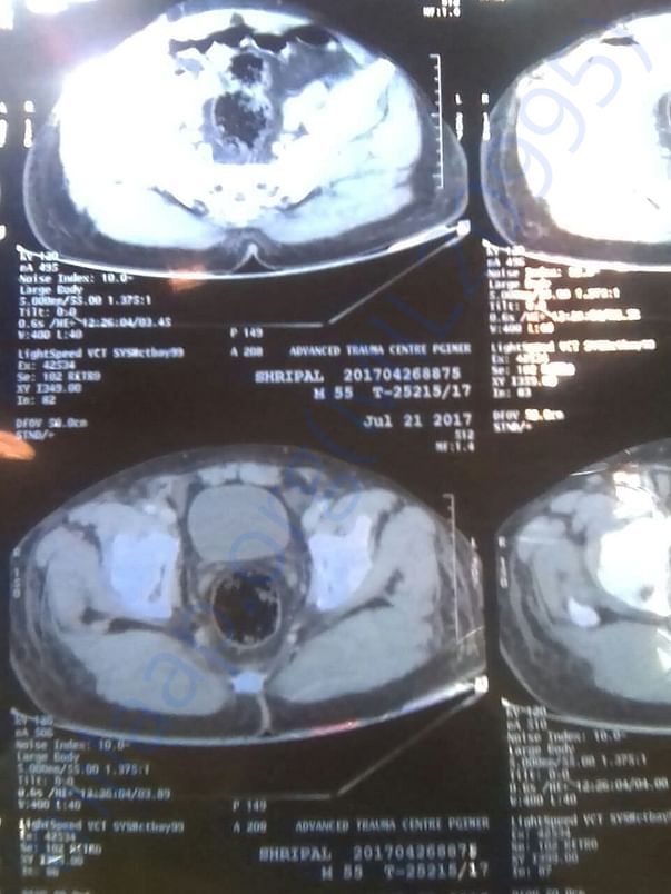 Tumor pic