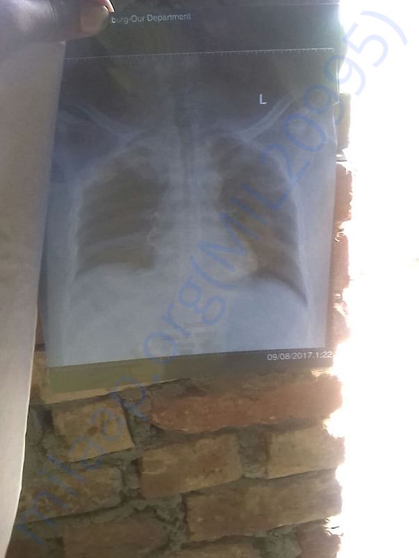 Lungs deteriorating