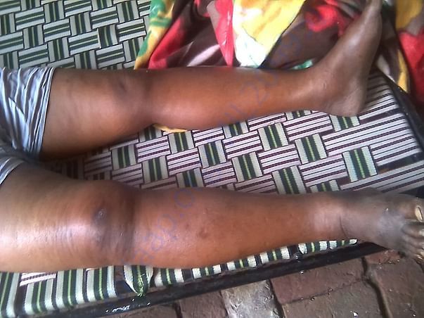 swelling all over body