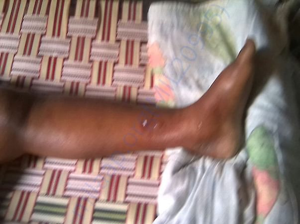 swelling