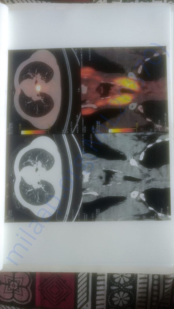 PET Scan