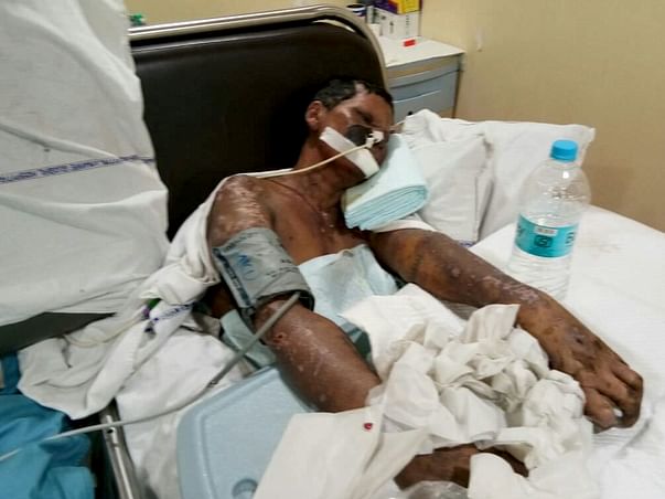 40-year-old Shevanta urgently needs treatment for severe skin disease