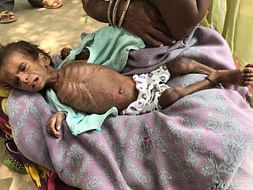 Save lives of 200 malnourished children in Rajasthan