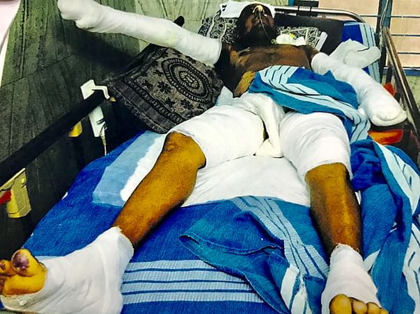 Help Prem Kumar To Recover From Skin Flame Burn