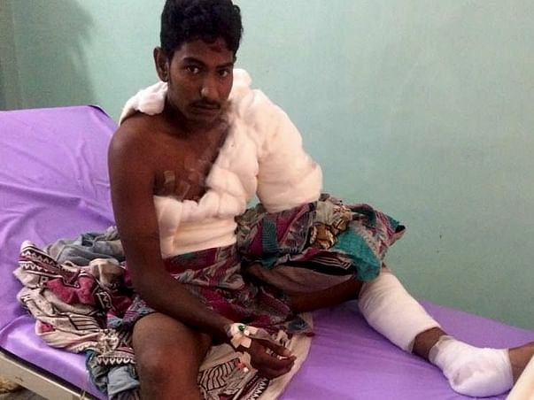 Help For Suresh's Surgery - Accidental Current shock - Kakinada