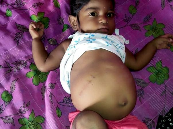 1-year-old Keerthana with a bloated stomach fights liver failure