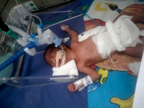 Requesting Help For Bharat's Premature Baby's Medical Expenses