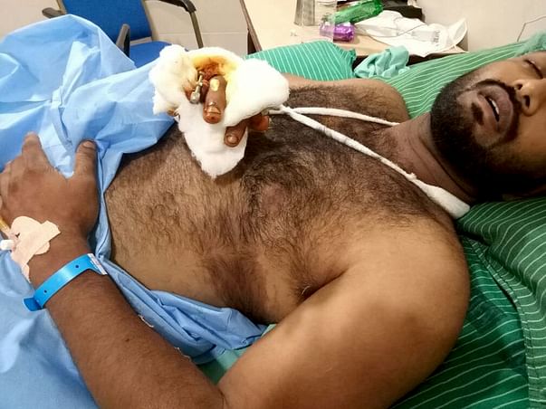 Help Muthu, An Athlete who lost his leg to walk again