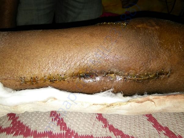 Knee condition
