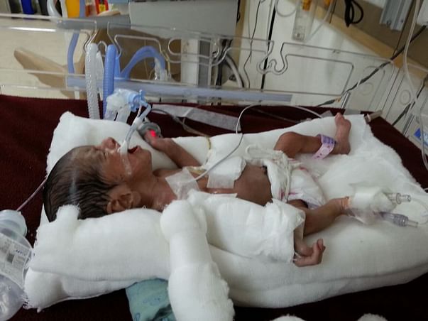 1-month-old Baby is Critically Ill & On Ventilator Needs Your Help