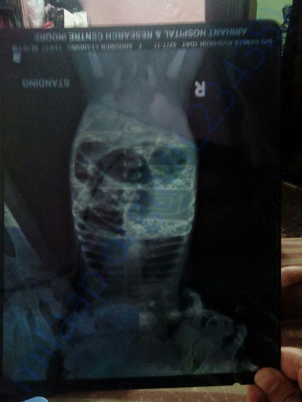 Meethi's Xray