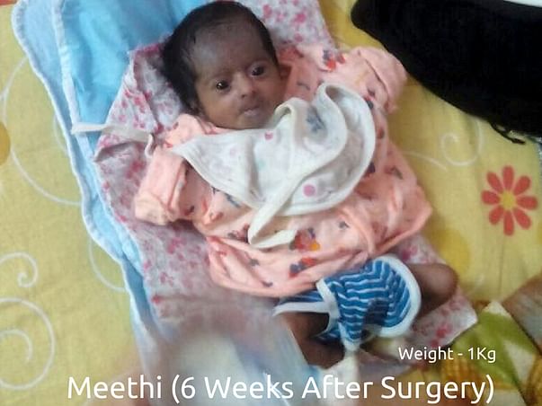 Help 2-Months Old Meethi Fight Intestinal Malrotation