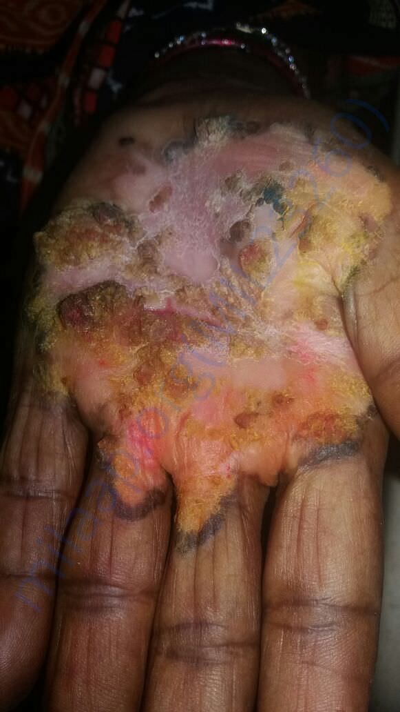 The condition of Ahalya Subudhi's hand