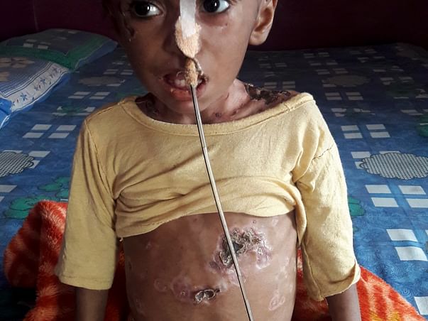 Help This 2-year-old Who Has A Disease That Is Eating Up Her Skin