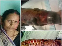 Help 55 -Year-Old Asha Devi Fight Against Necrotizing Fasciitis