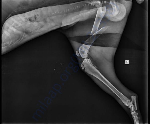 Snoopy Fracture X-ray