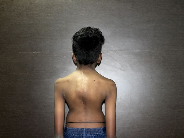 Help 16-year-old Balaji fix his severely deformed spine