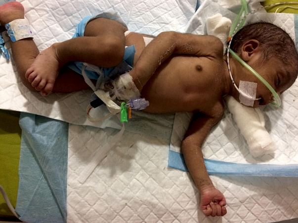 Reema's new born is on life support and fights to survive
