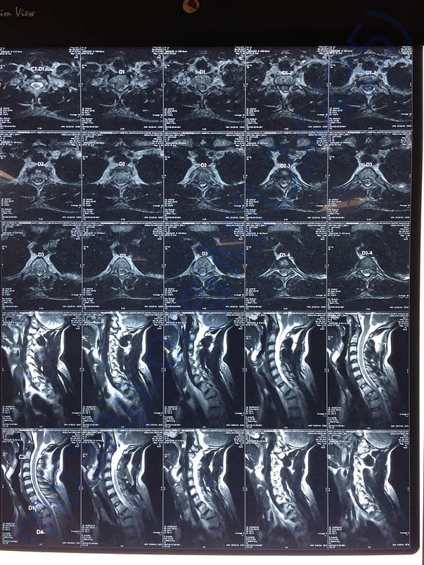 Spine Scan