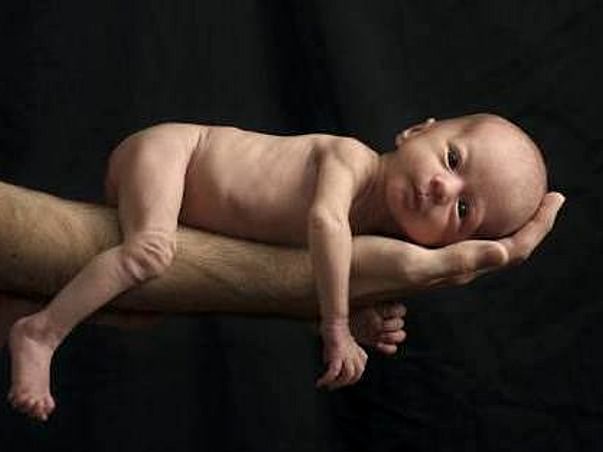 Help Preterm twin babies treatment to recover from extreme prematurity