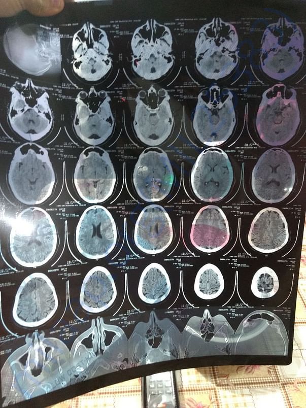 Brain tumor documents as of now