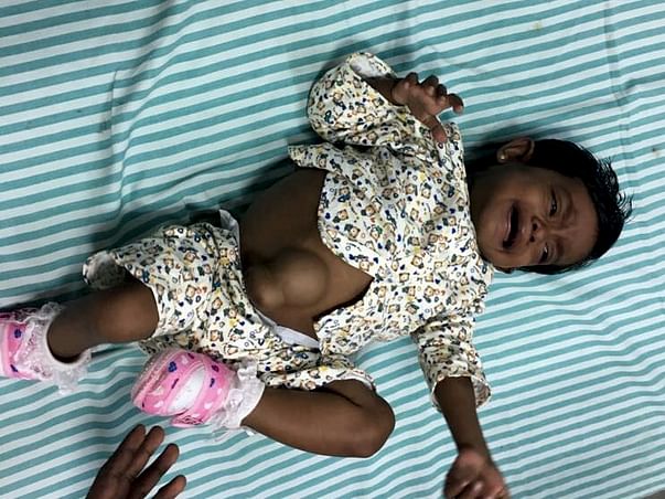 Help This 1-year-old Srilankan Baby Who Has End-stage Liver Disease