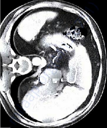 Liver scanning report showing cirrhosis