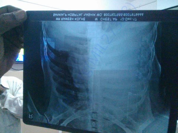 Chest X-ray