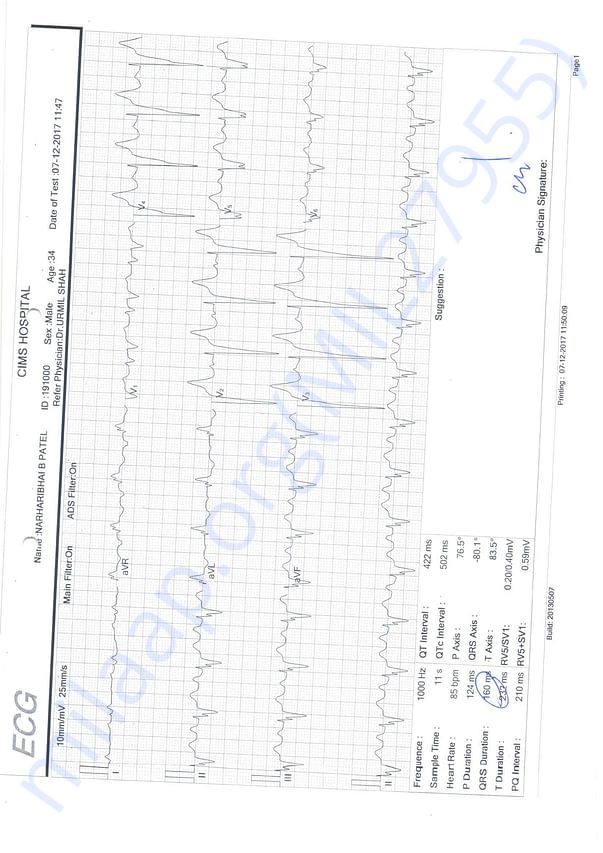 ECG
