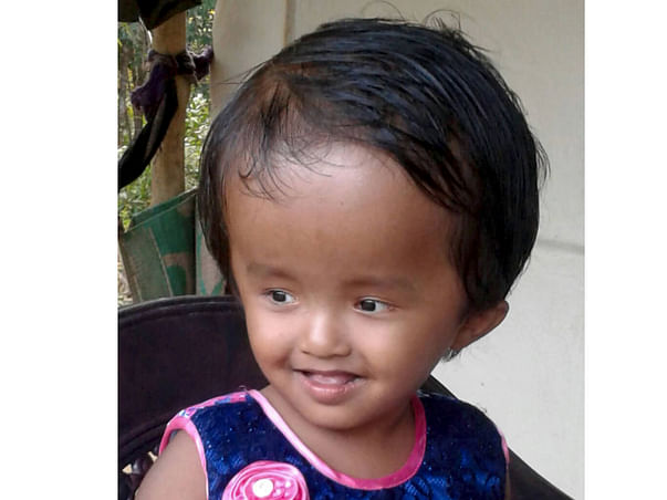 Help Little Reshmi Fight Hydrocephalus