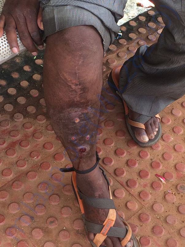 Had to have metal rod put in his leg - botched by first doctor