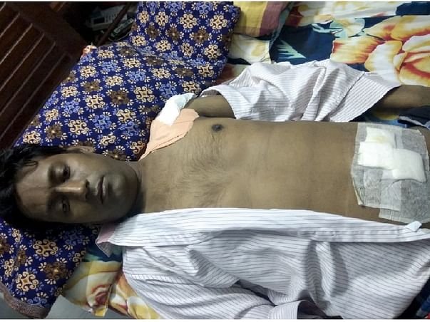 Help My Brother Undergo A Renal Transplantation Surgery