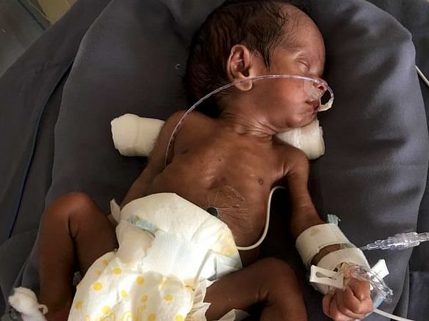 These Parents Need Your Help To Save Their Prematurely Born Baby Boy