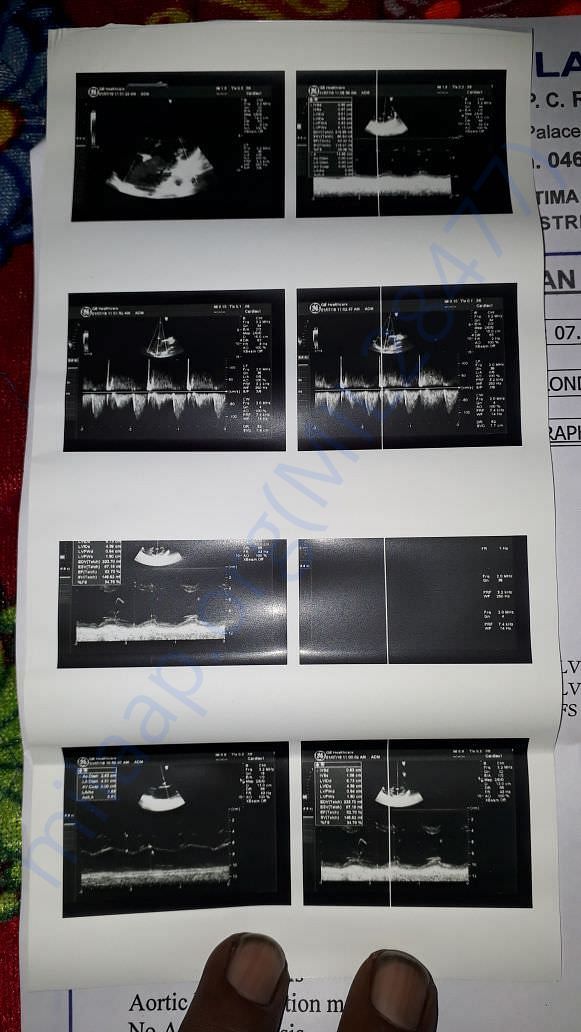 Echo images