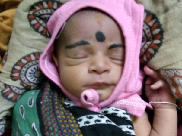 Baby sonali Heart surgery