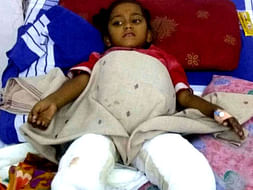 5-Year-Old Kavya Needs Urgent Surgery To Recover From Severe Burns